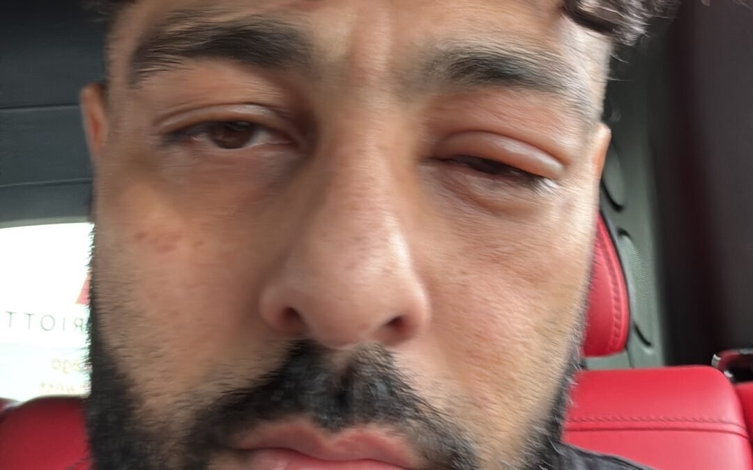 बादशाह की आंख पर चोट की तस्वीरें वायरल, फैंस हुए परेशान – जानिए असली सच